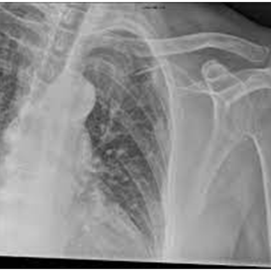 x-ray clavicle left side